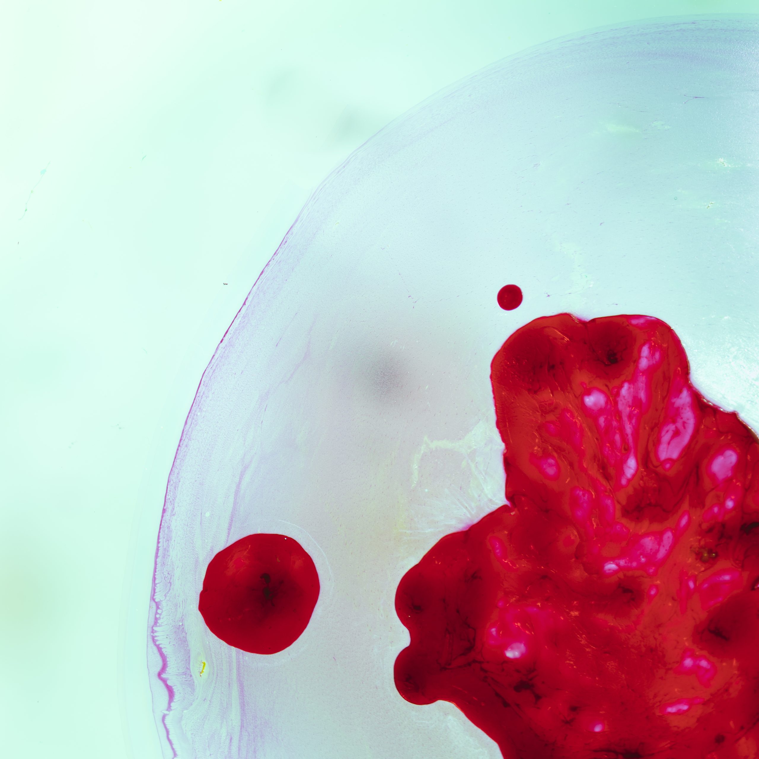 How Does Thalassemia Affect Daily Life