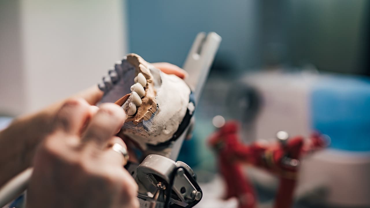 dental bone transplant