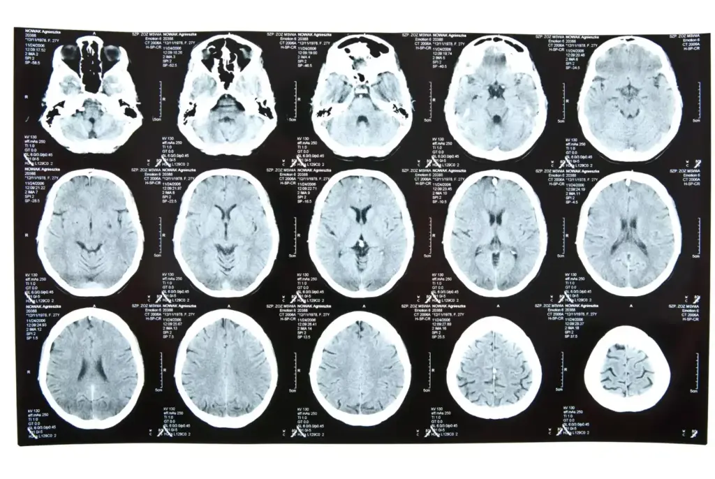 different brain tumor specimens