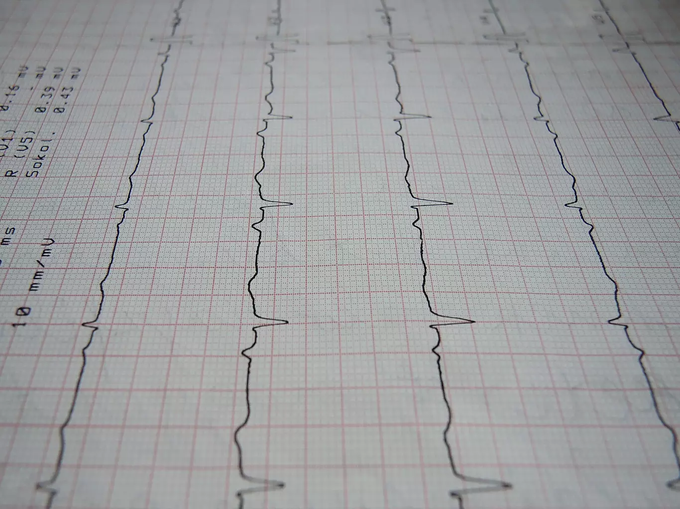 does atrial fibrillation cause strokes