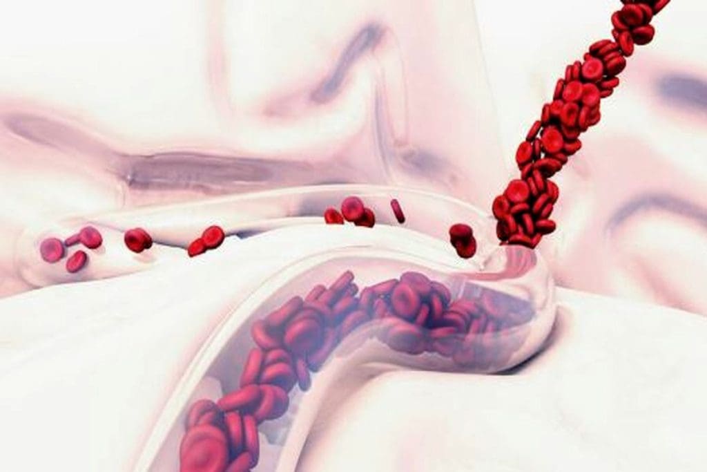 Thrombocytopenia: Negative Cause of Bleeding