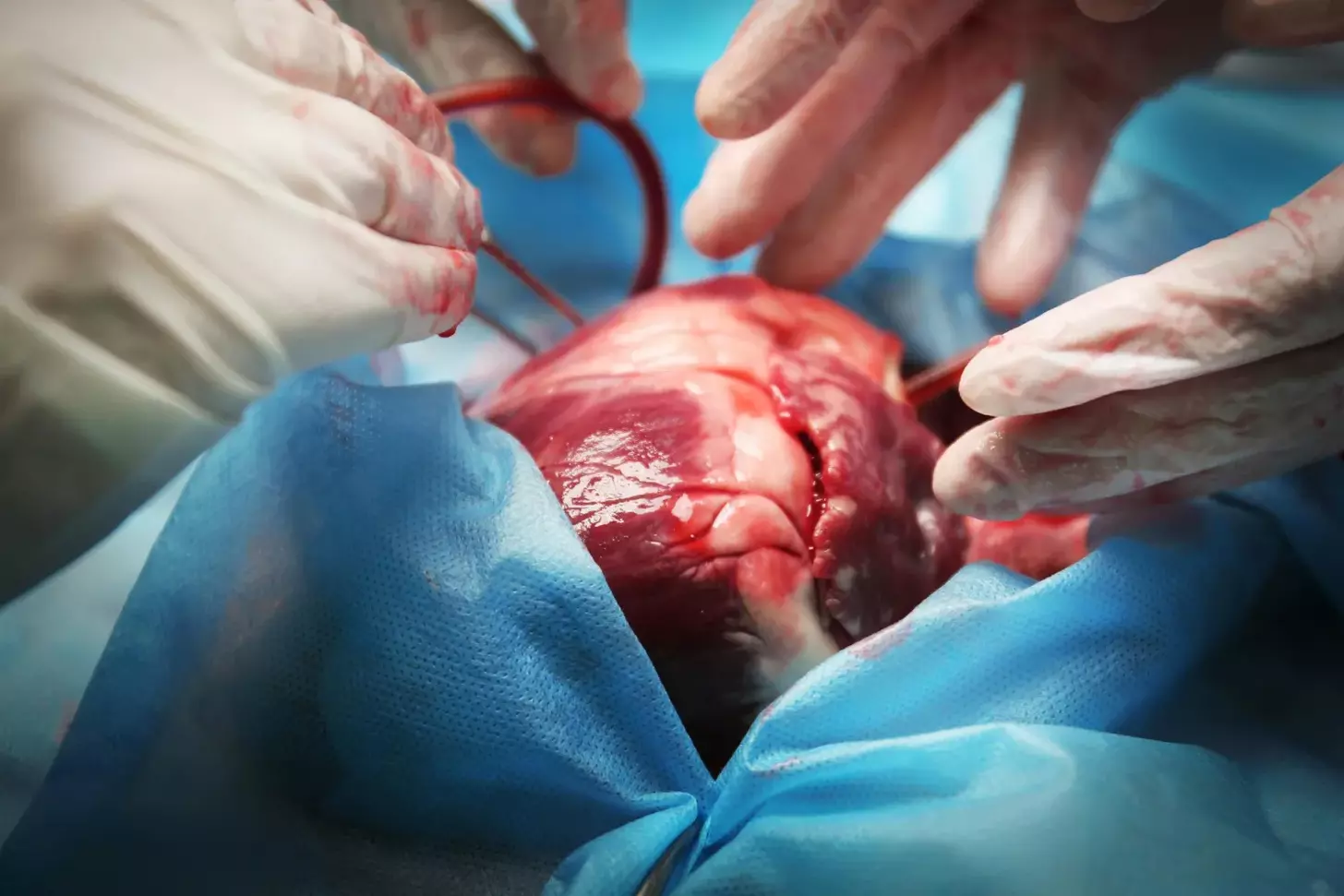 endoscopic coronary artery bypass surgery