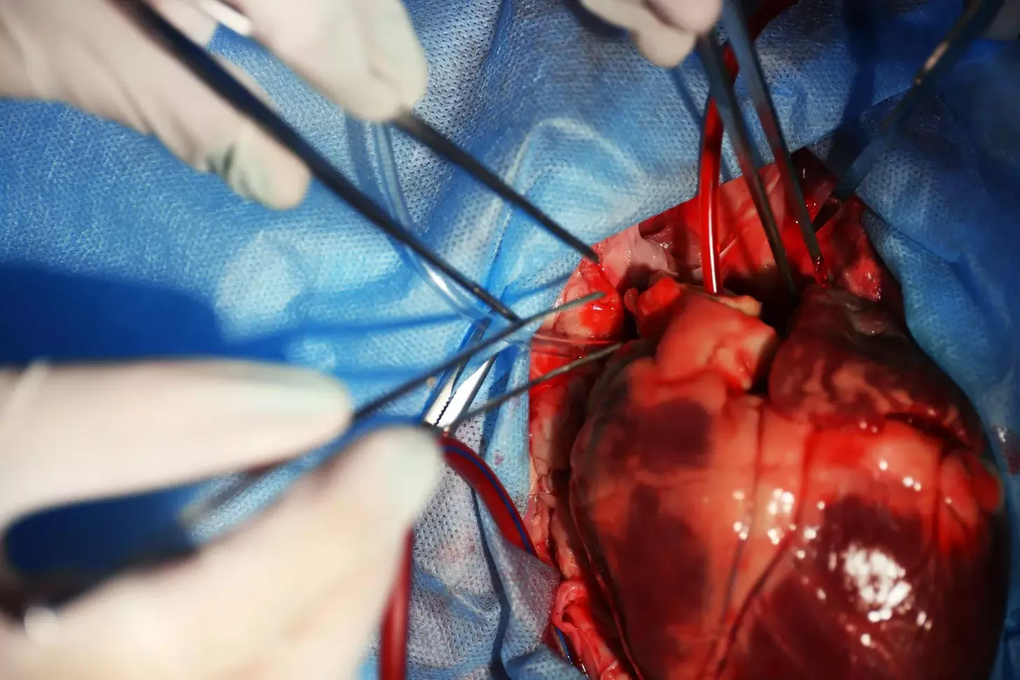 endoscopic heart bypass