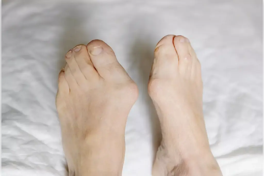 hallux valgus surgery recovery