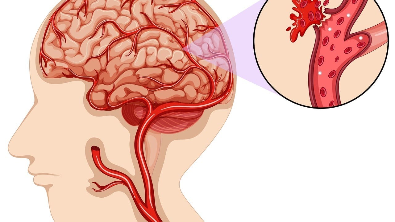 hardening of the arteries in the brain symptoms