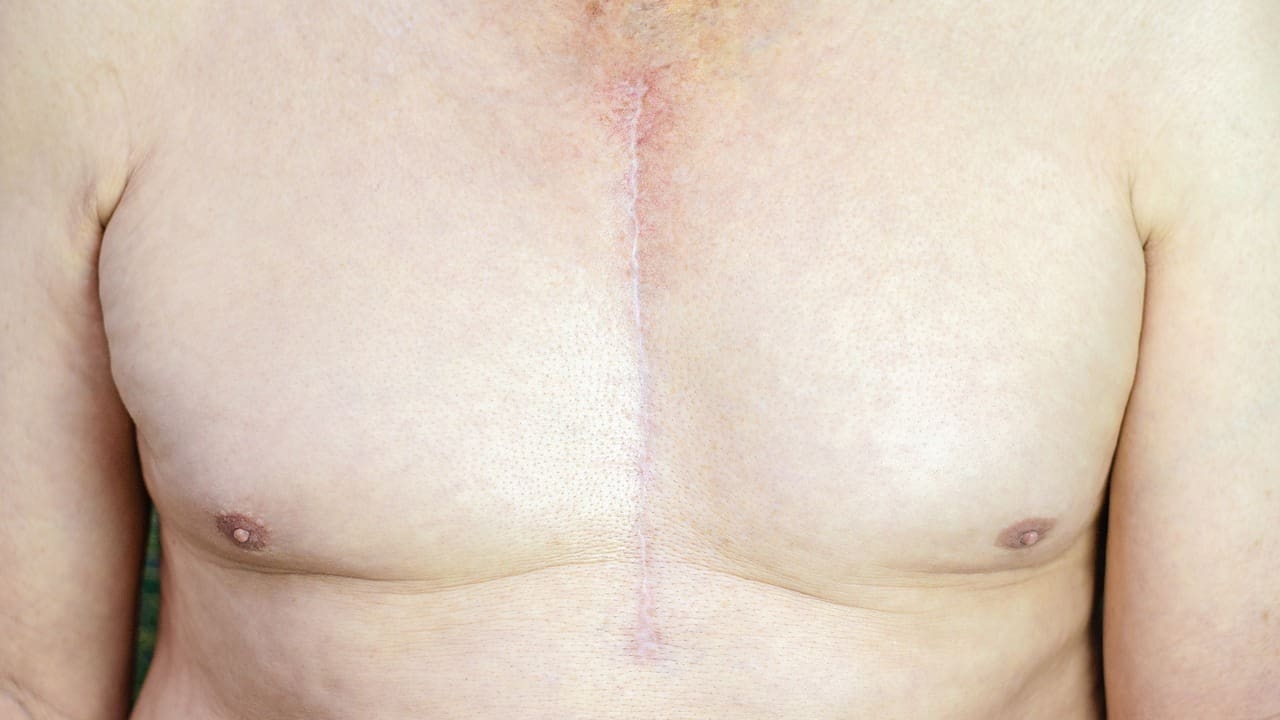 heart valve replacement scar