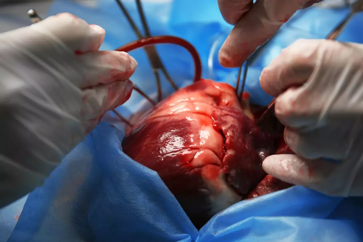 heart valve replacement surgery