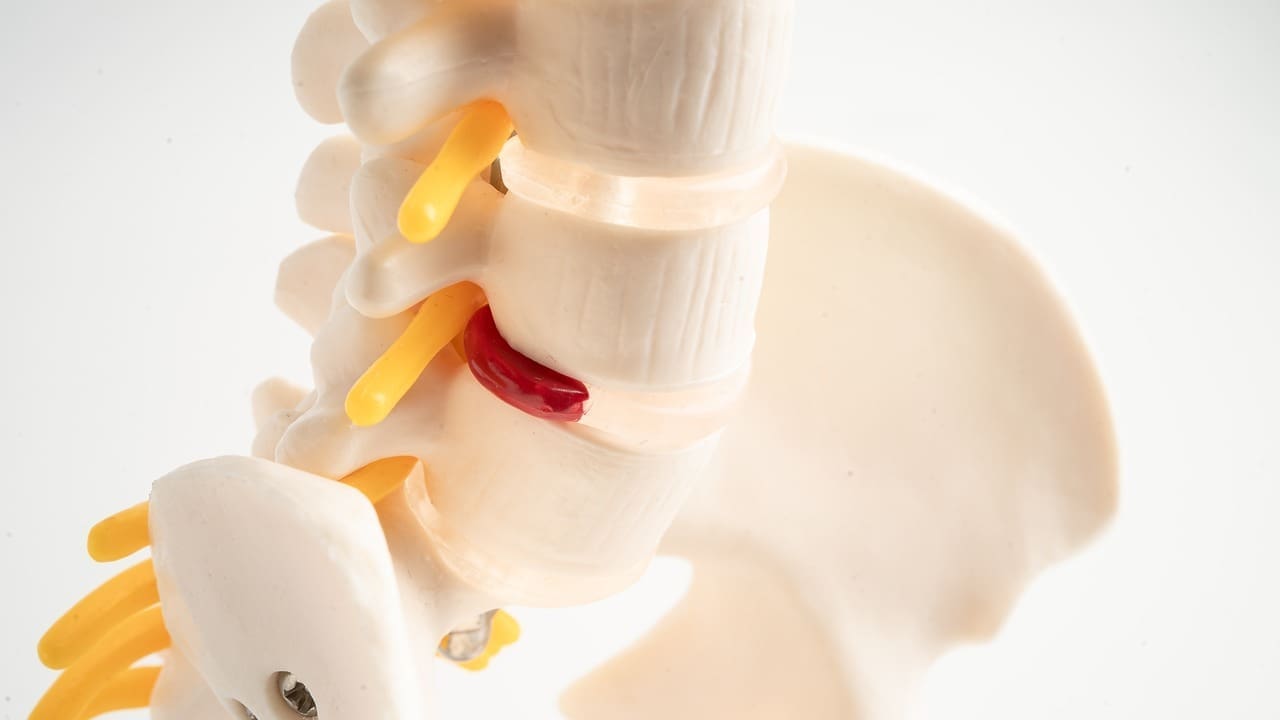 herniated disk image