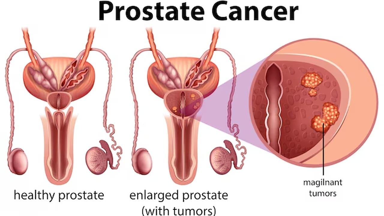how fast does aggressive prostate cancer grow