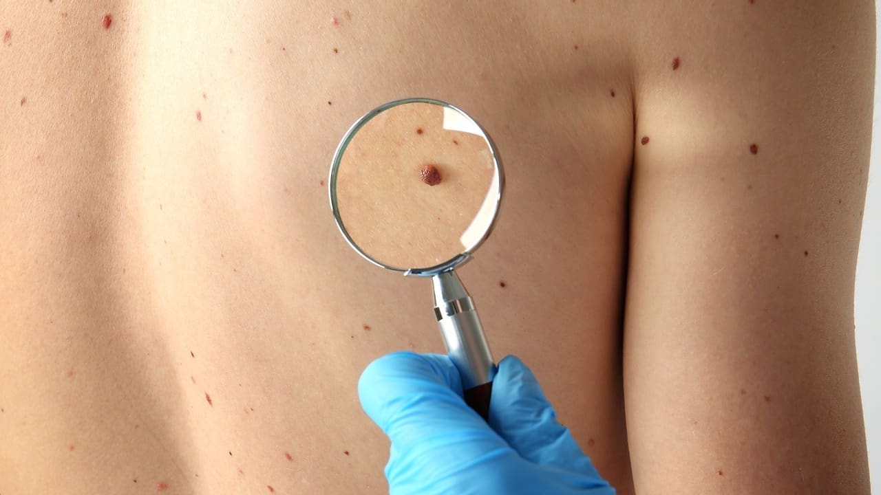 how long can you survive with skin cancer