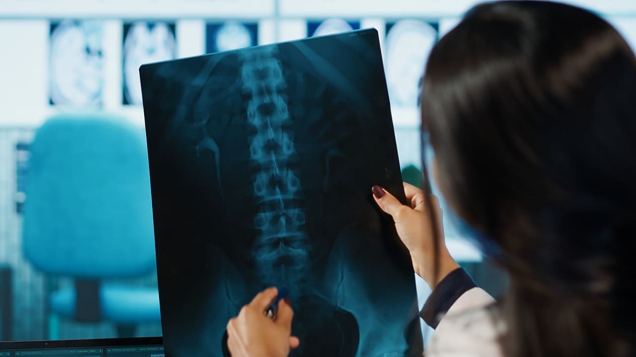 how long do spinal fusions last
