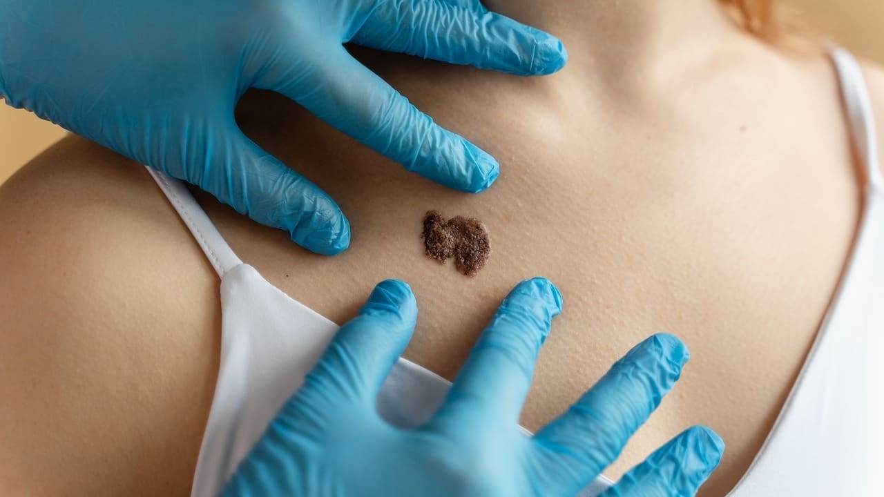 how many people have skin cancer