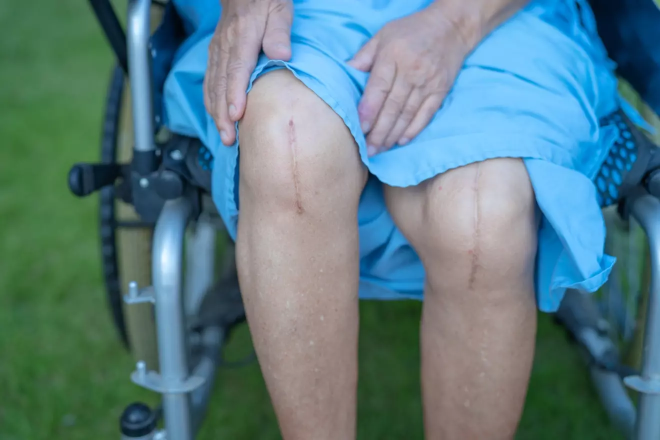 ice after knee replacement