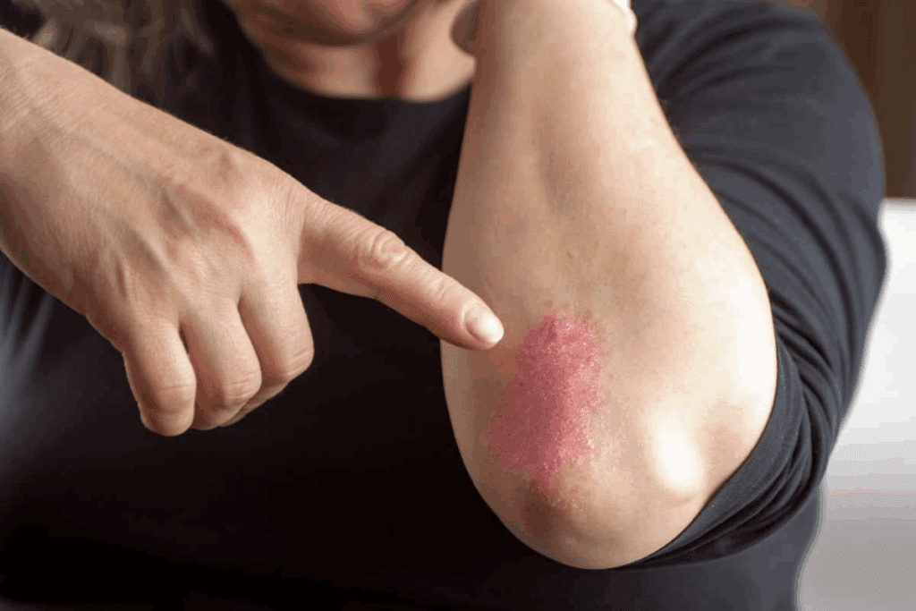 Latest Medicine for Psoriatic Arthritis Treatment Options