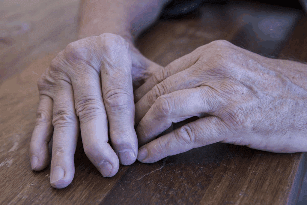 Psoriatic Arthritis Stroke Risk: What Studies Show 1 Psoriatic Arthritis Stroke Risk: What Studies Show