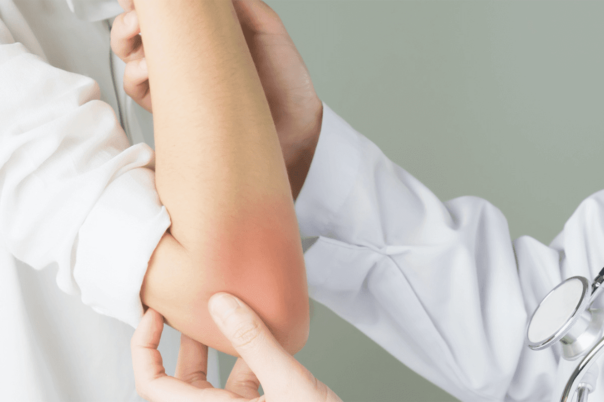 Most Effective Psoriatic Arthritis Treatment Options