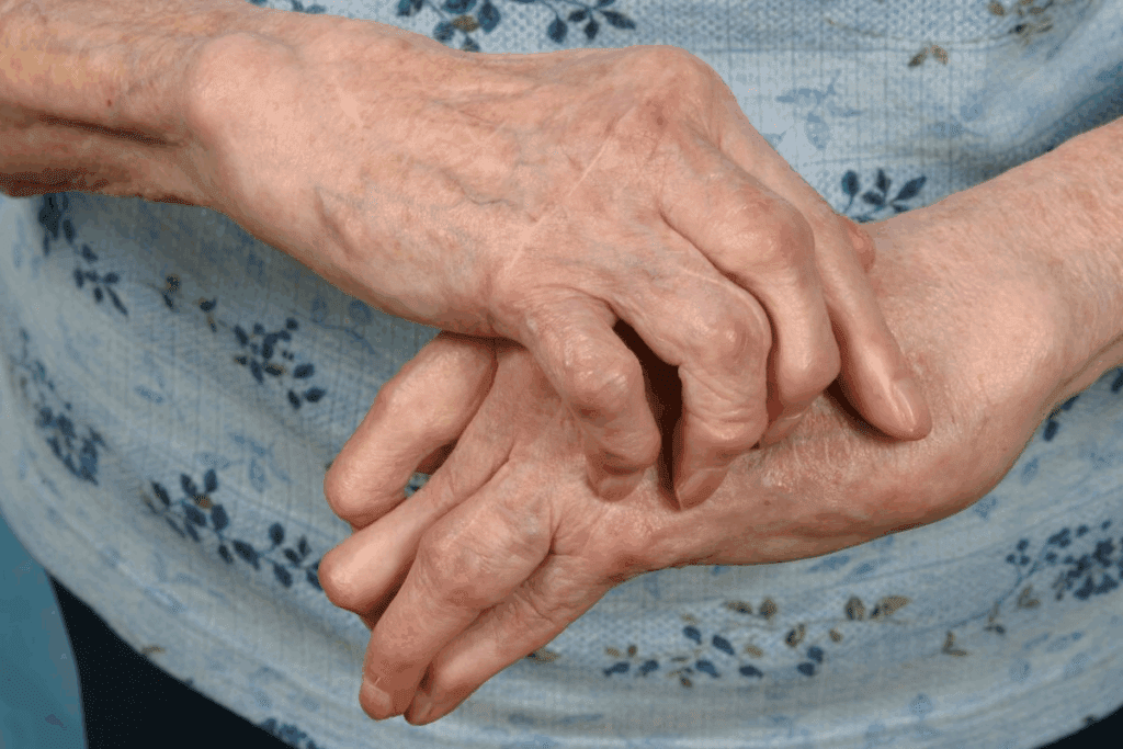 Most Effective Psoriatic Arthritis Treatment Options