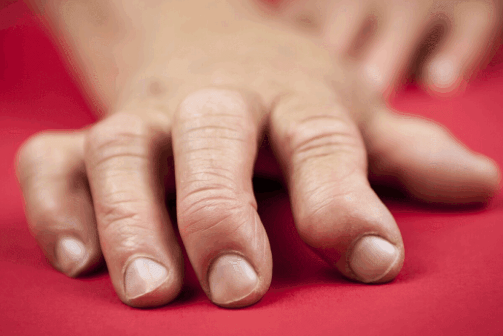 Common Psoriatic Arthritis Triggers You Should Avoid