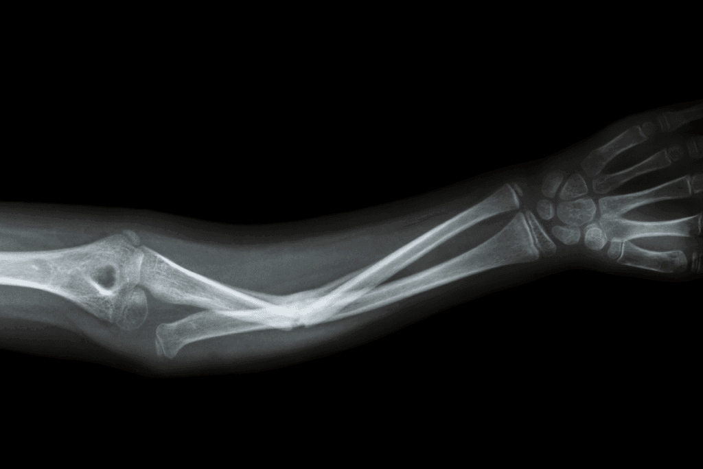 Worsening Fracture Signs to Watch For 3 Worsening Fracture Signs to Watch For