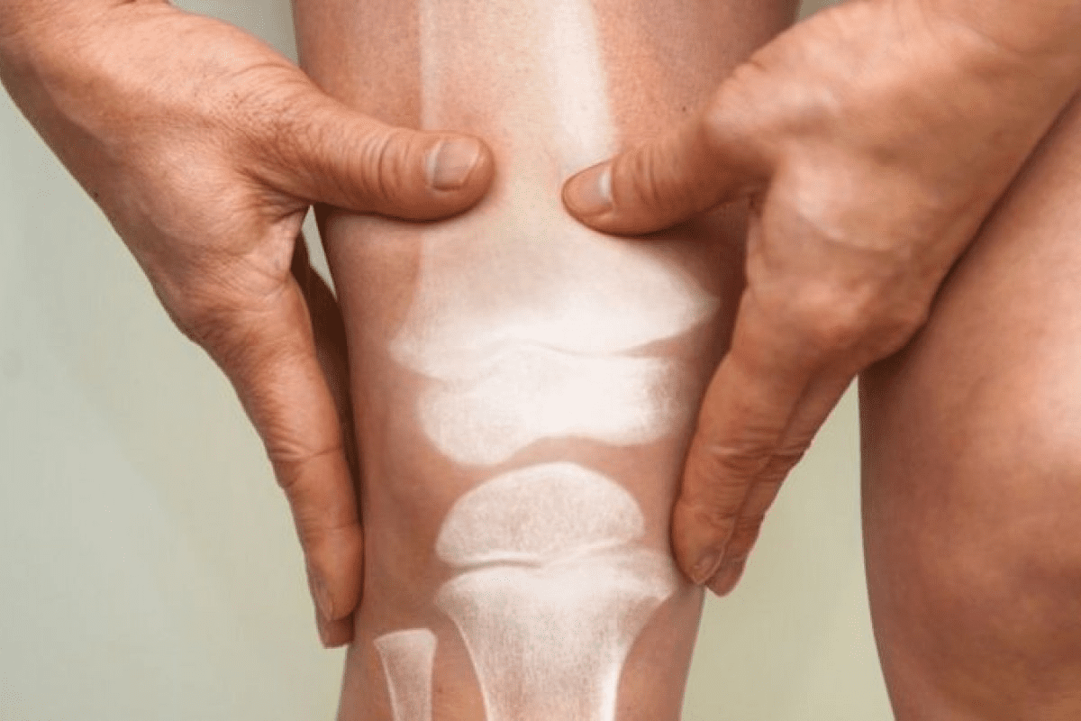 Knee Arthritis Exercises to Avoid Doing