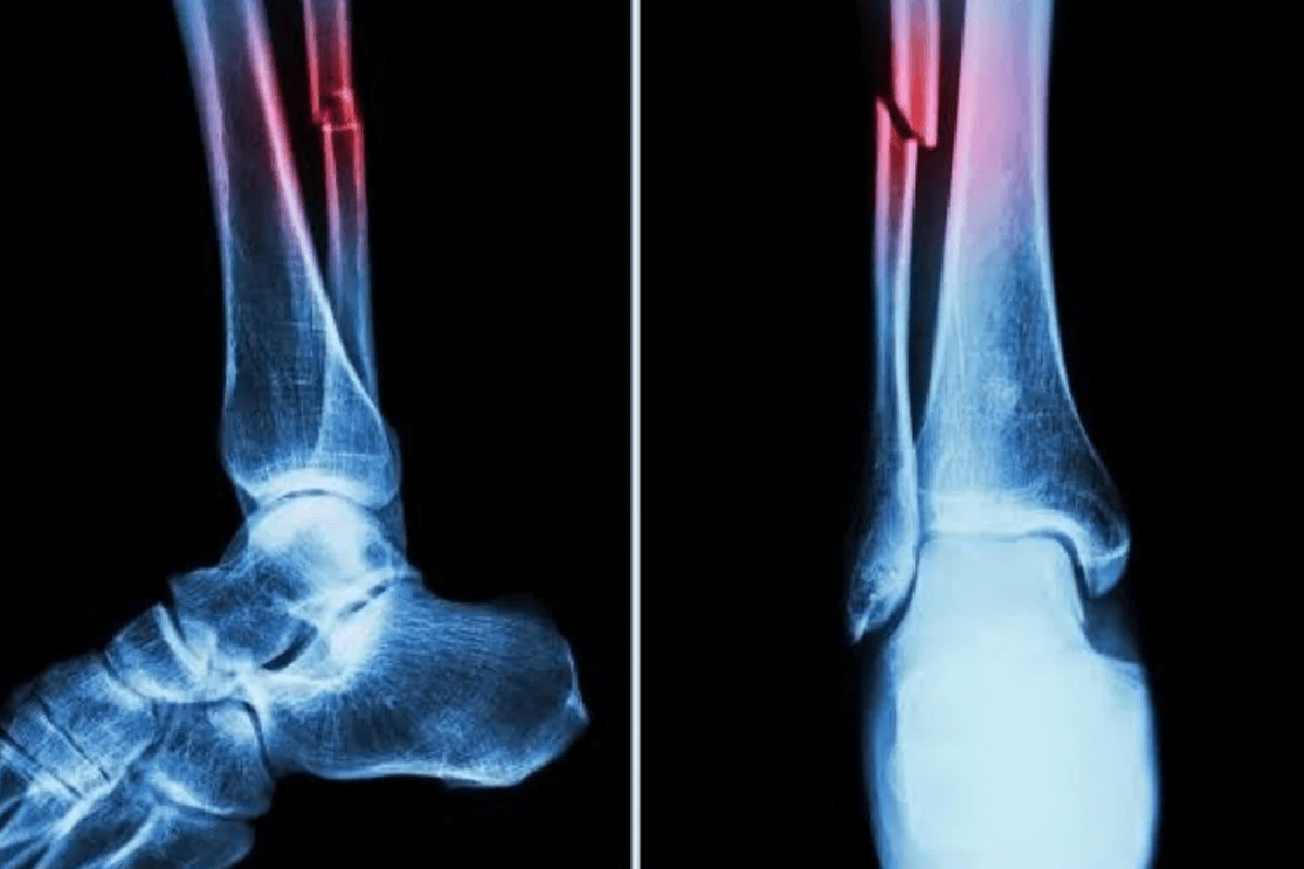 Serious Bone Fractures and Their Risks