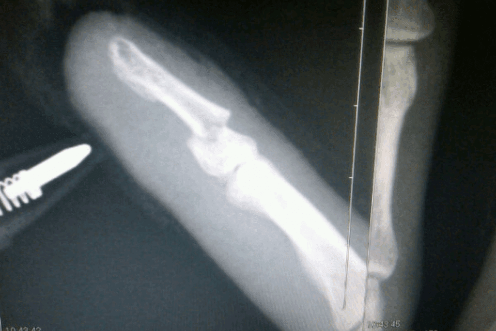 Fractured Finger Treatment and Recovery 2 Fractured Finger Treatment and Recovery