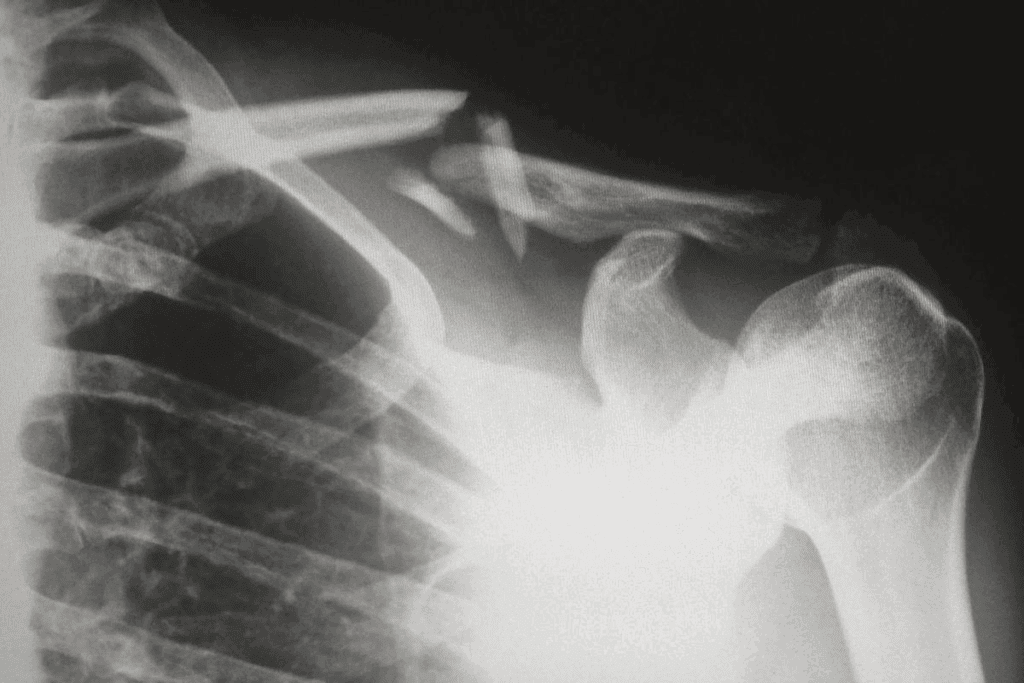 Fracture Healing Interference Causes