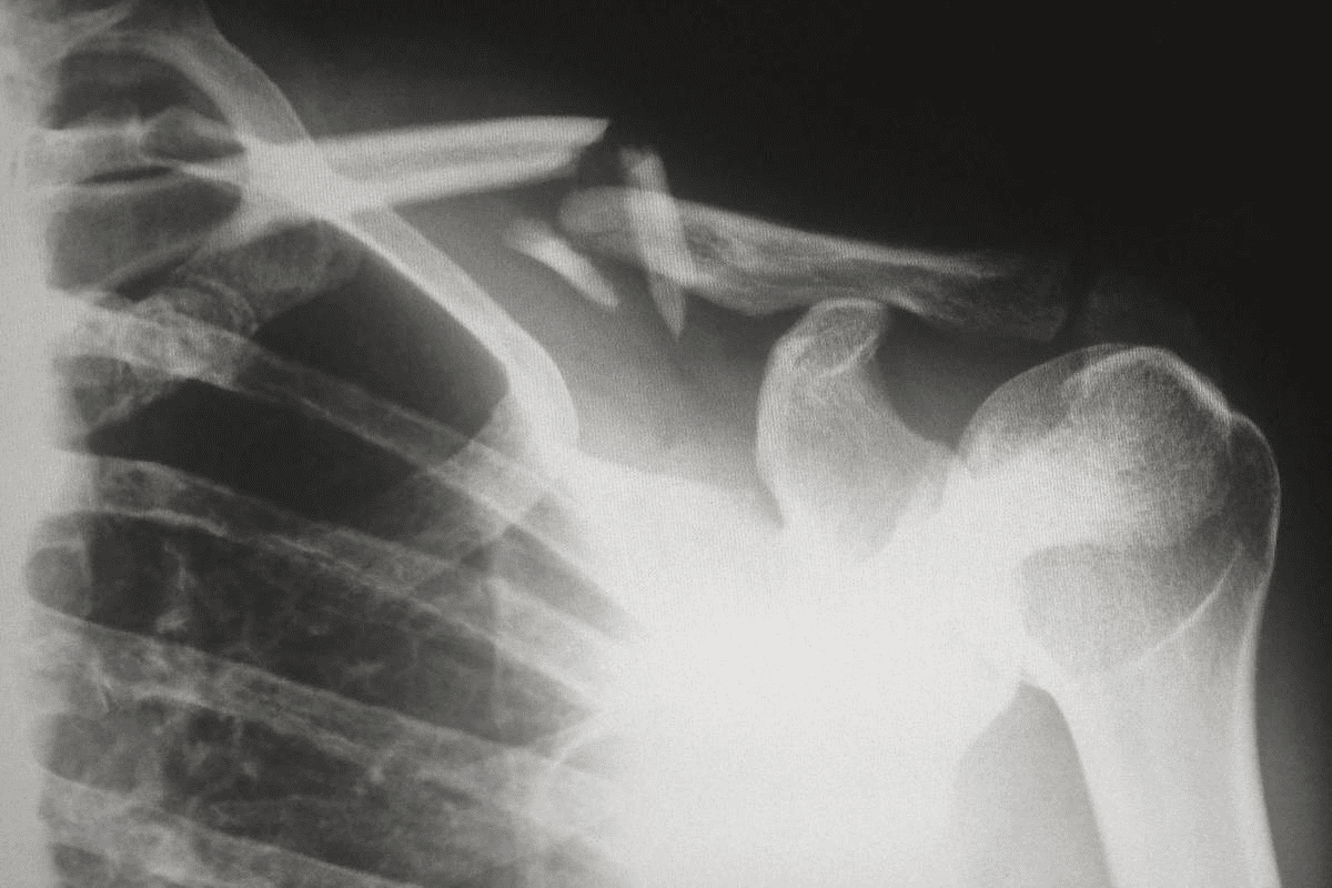 Fracture Healing Interference Causes