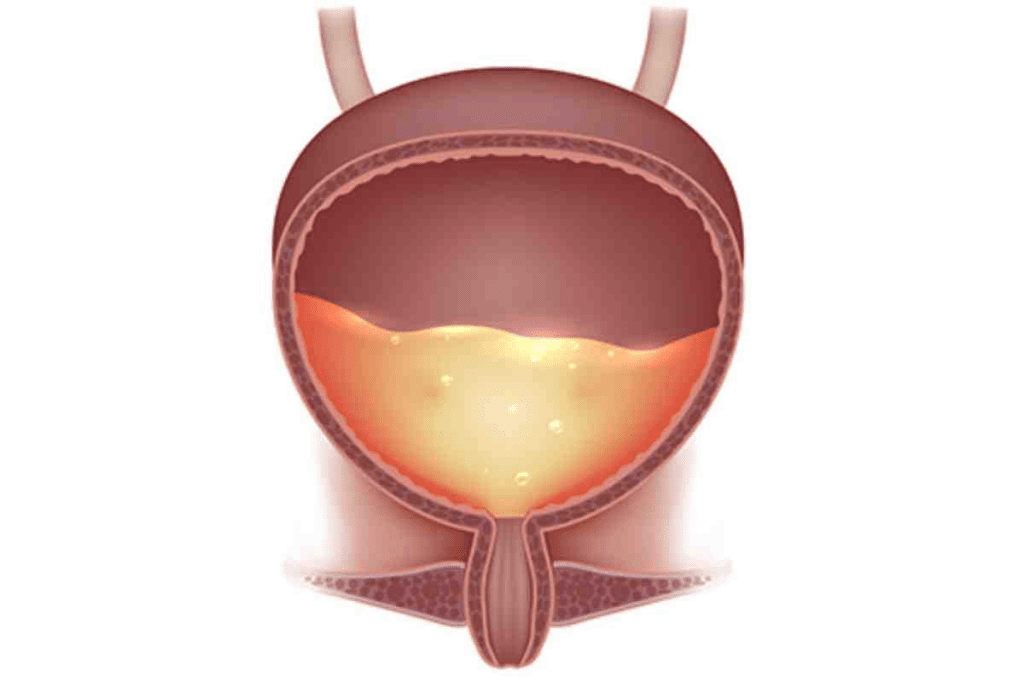 Neurogenic Bladder: Crucial 4 Types Explained