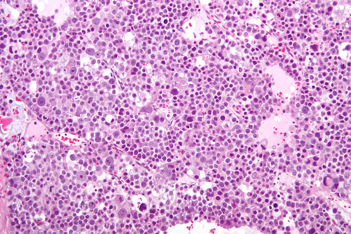 Symptoms of Bone Marrow Disease: Key Warning Signs