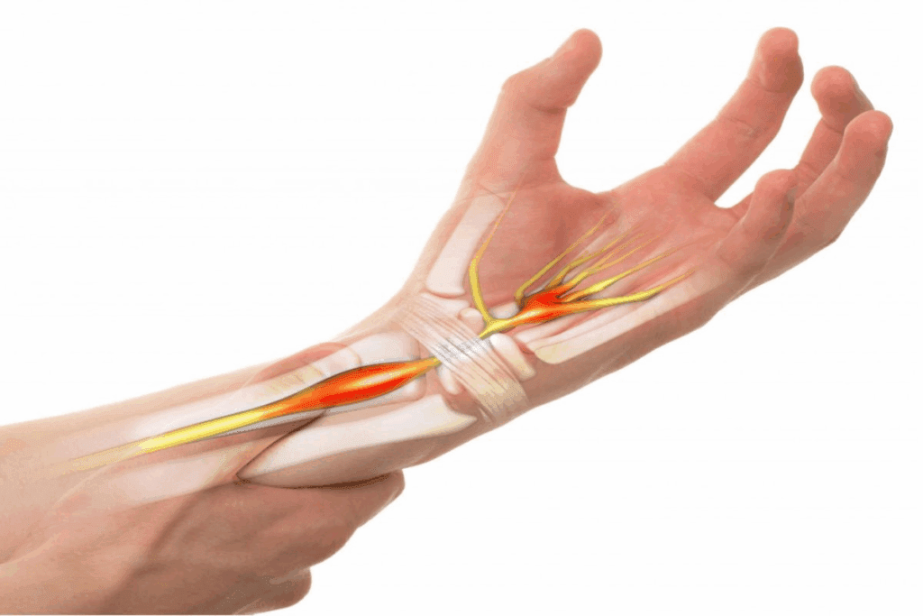 The 5 Stages of Carpal Tunnel Syndrome 1 The 5 Stages of Carpal Tunnel Syndrome