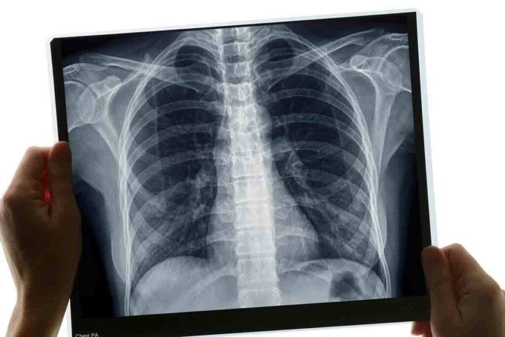 Chest X Ray Dose: 7 Ultimate and Powerful Facts