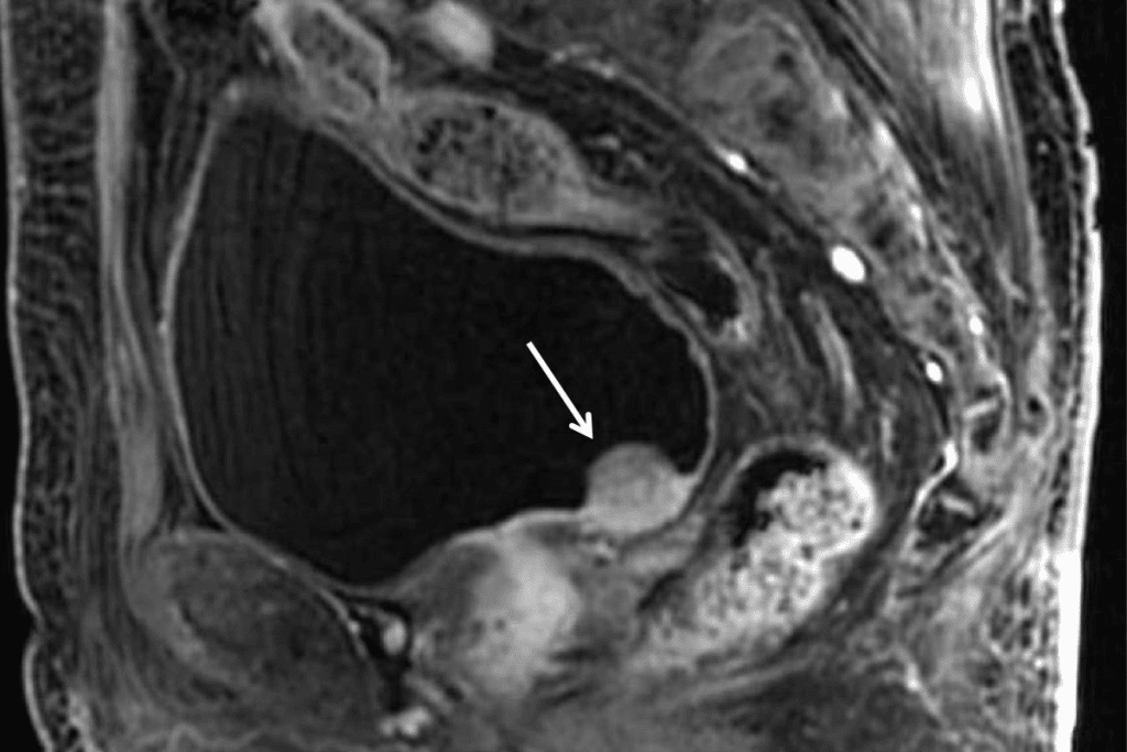 What Percentage of Bladder Tumors Are Cancerous:Aggression