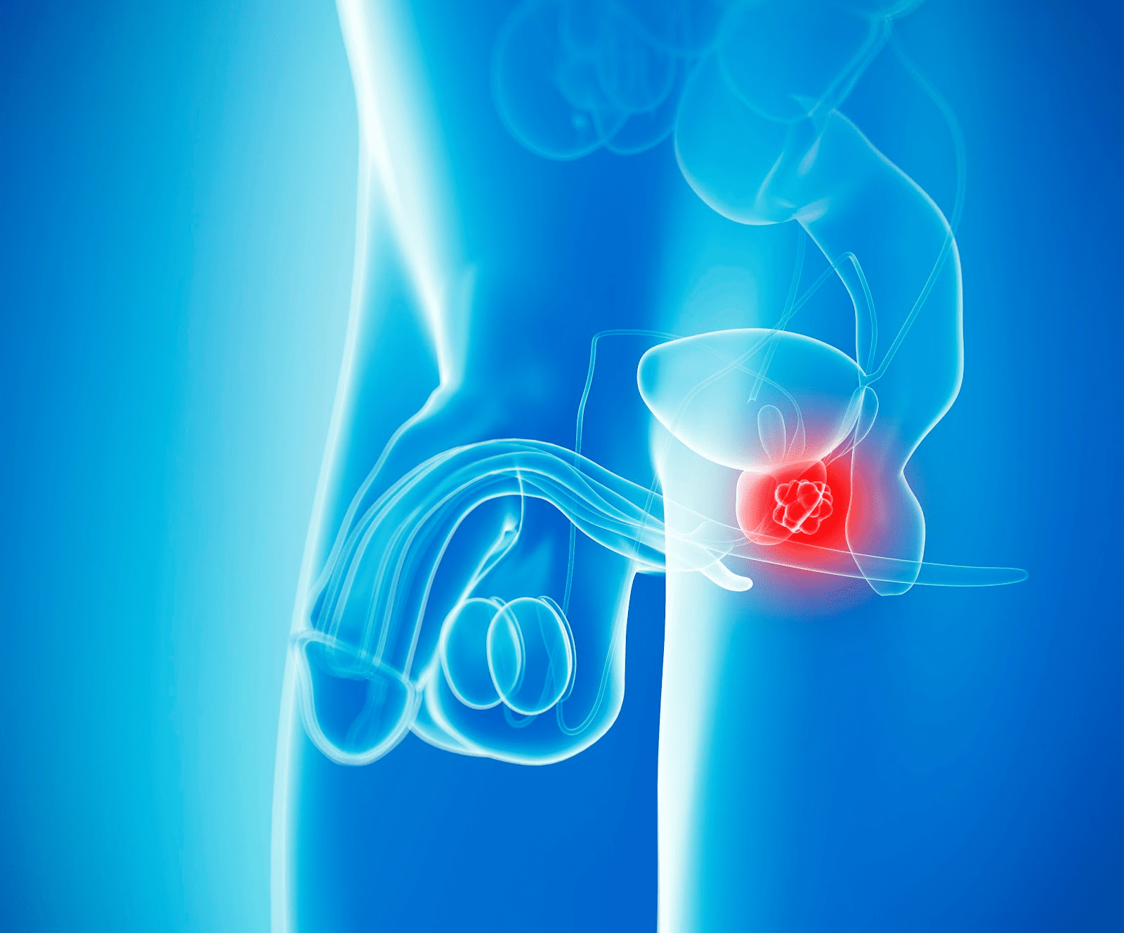 Metastatic Bladder Cancer: First Organ Spread