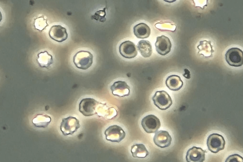 Bladder Cancer Symptoms: Negative Pain Facts 3 Bladder Cancer Symptoms: Negative Pain Facts