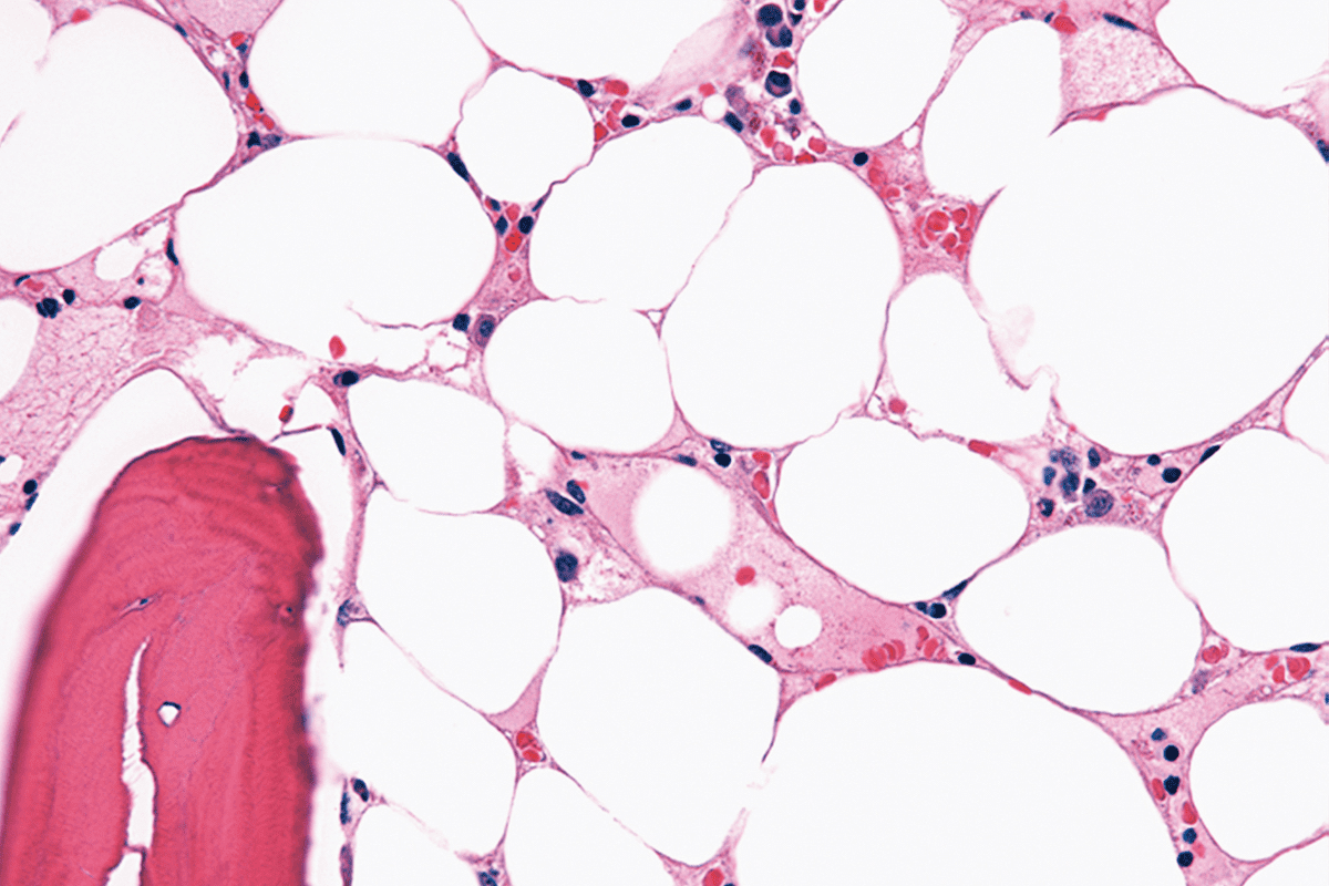 Anemia Chart: 5 Key Types Simplified