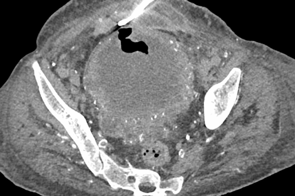 Bladder Cancer Survival Rate: Positive Long Life Fact