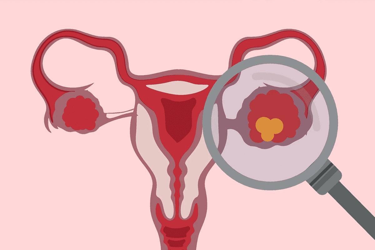 Cystectomy: Positive Life Without Your Bladder