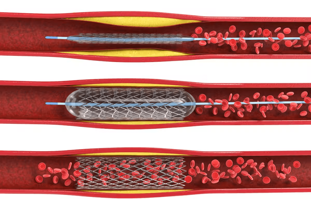 Balloon Angioplasty: Step-by-Step Guide