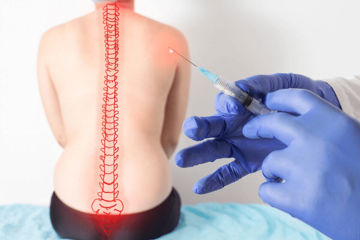 Cervical Epidural Injection: 7 Key Facts