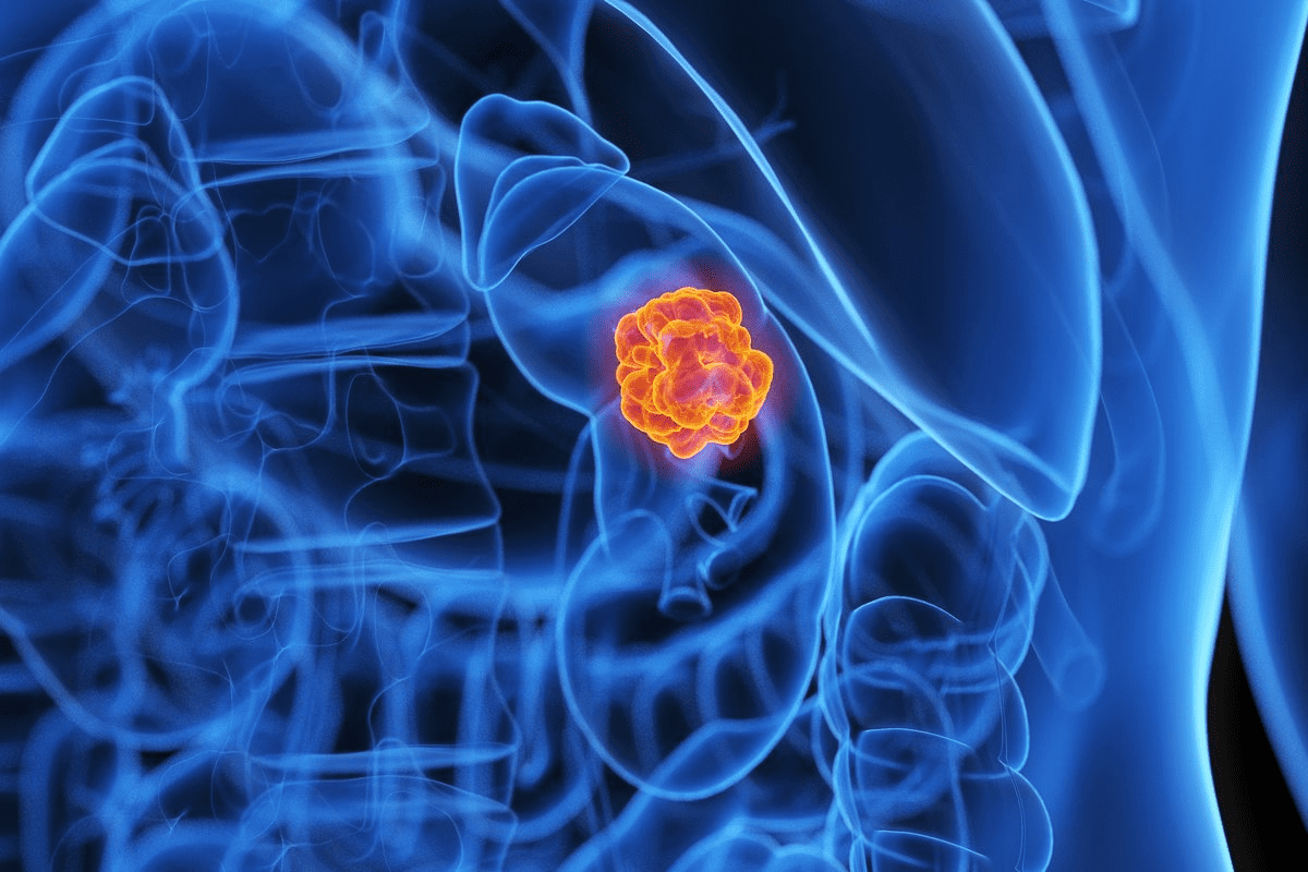 7 Essential Facts About Ablation for Kidney Cancer: Procedures, Benefits, and Risks | Ablation Kidney Cancer