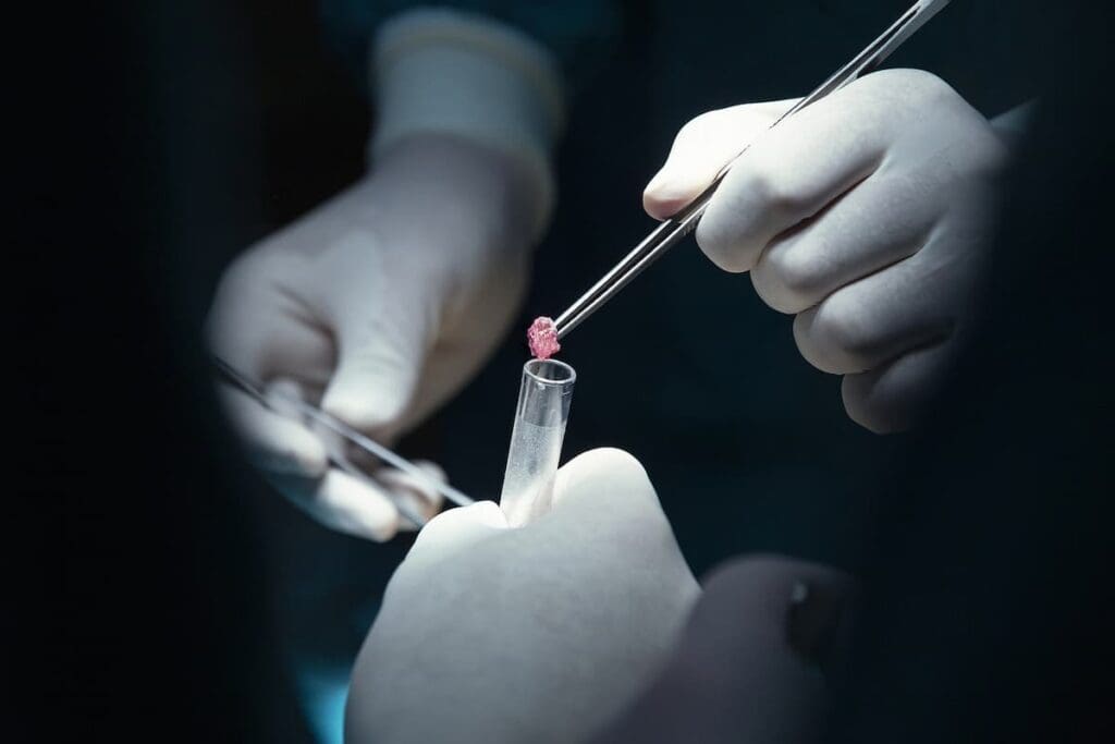 The Truth About Prostate Biopsy: Why MRI Offers a Better, Safer Option