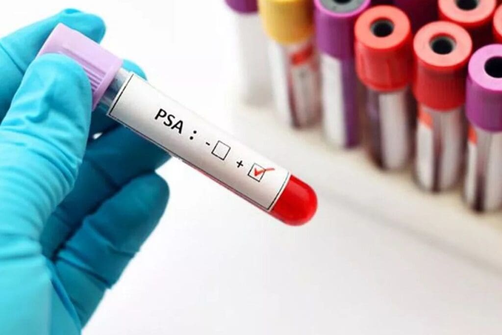 What Not to Do Before PSA Test | Causes of Elevated PSA