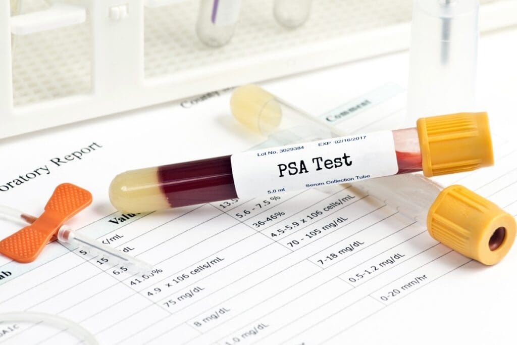 What Not to Do Before PSA Test | Causes of Elevated PSA