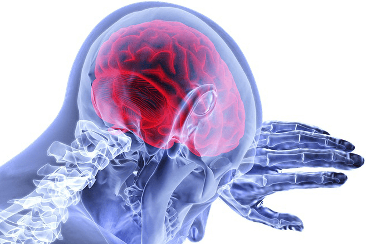 How to coil embolization aneurysm: Step-by-Step Procedure