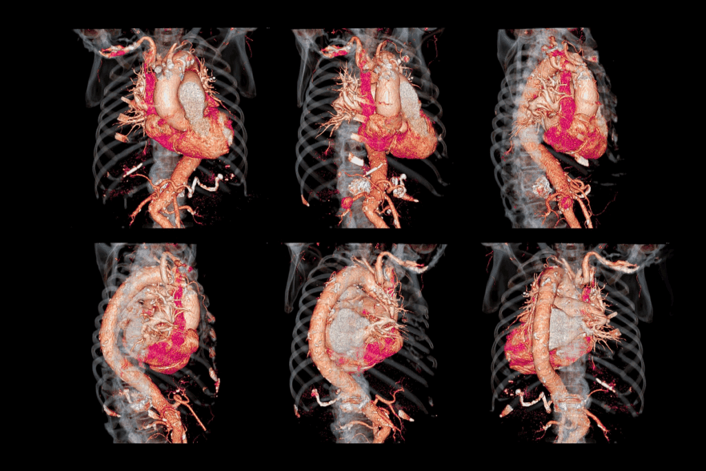 EVAR Stent Procedure: Abdominal Aortic Aneurysm