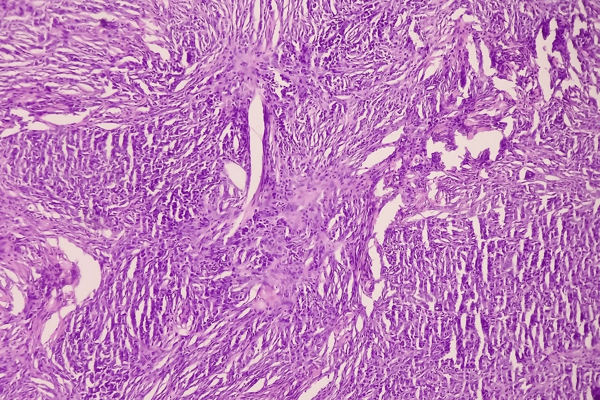 Benign Neoplasm of Colon: What You Need to Know