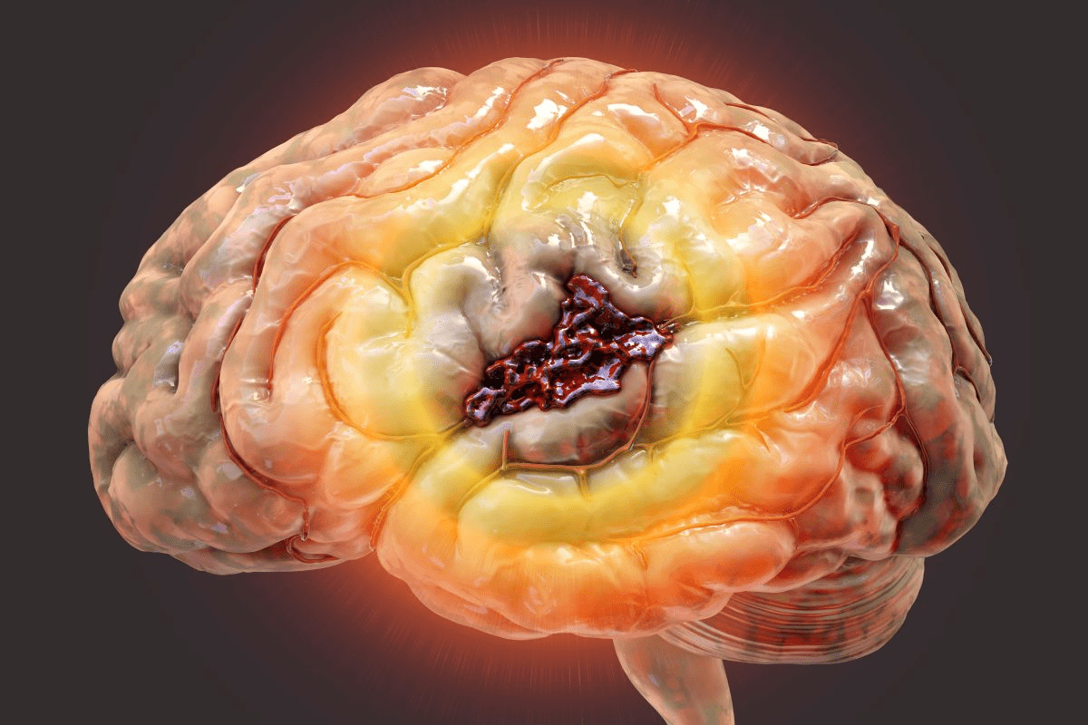 1 Solution for Hemorrhagic Stroke: which stroke type is treated with endovascular coiling