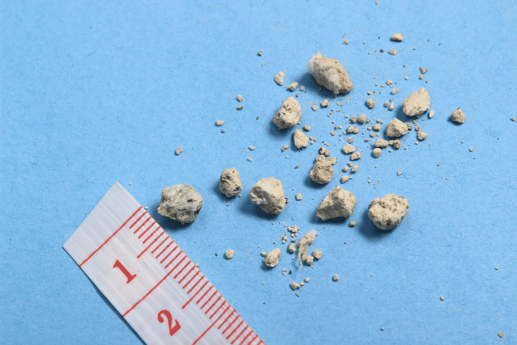 Kidney Stones: Dangerous 7 mm Size Fact