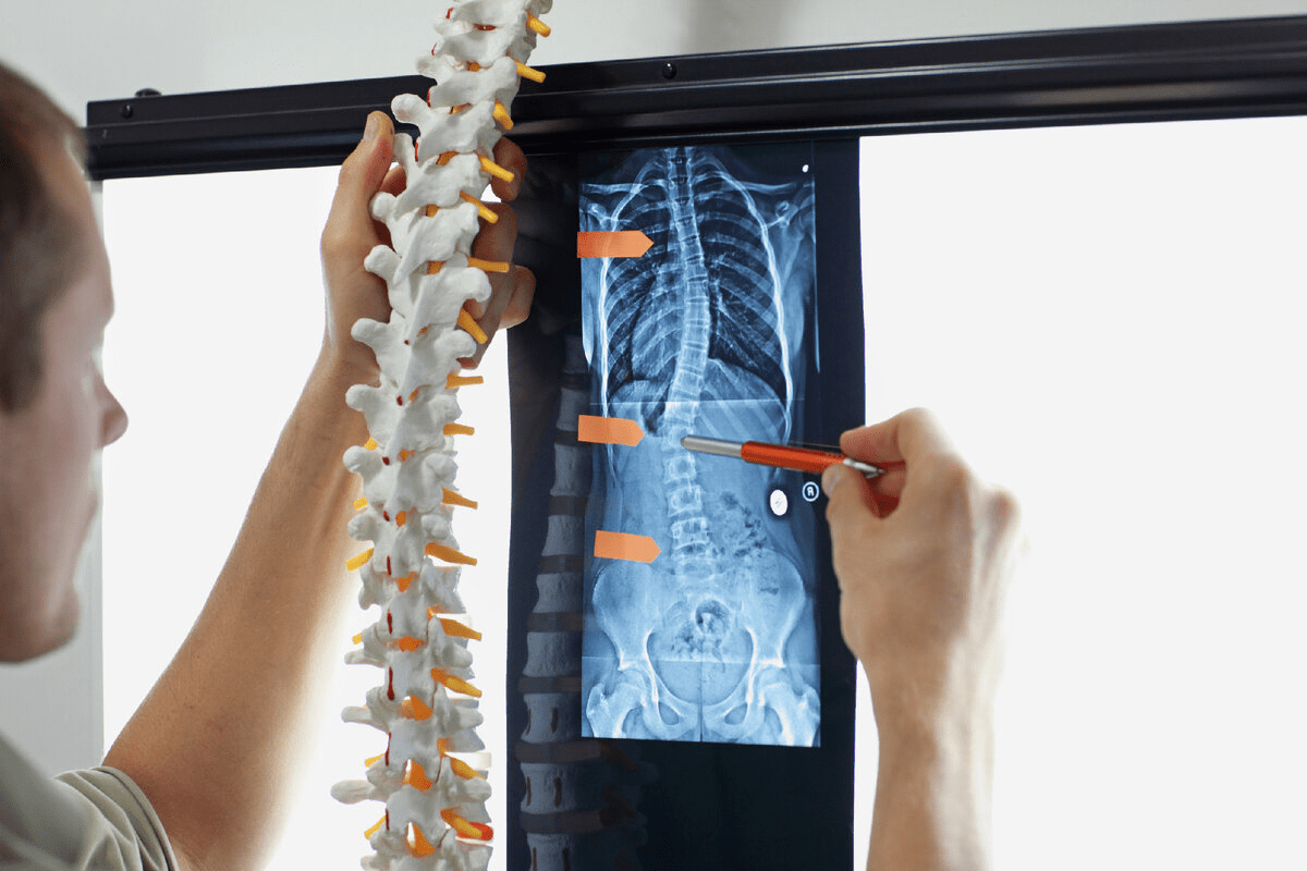L1 Vertebrae Fracture: 10 Key Facts & Treatments
